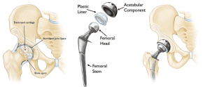 Joint Replacement | Southern Bone & Joint Specialist